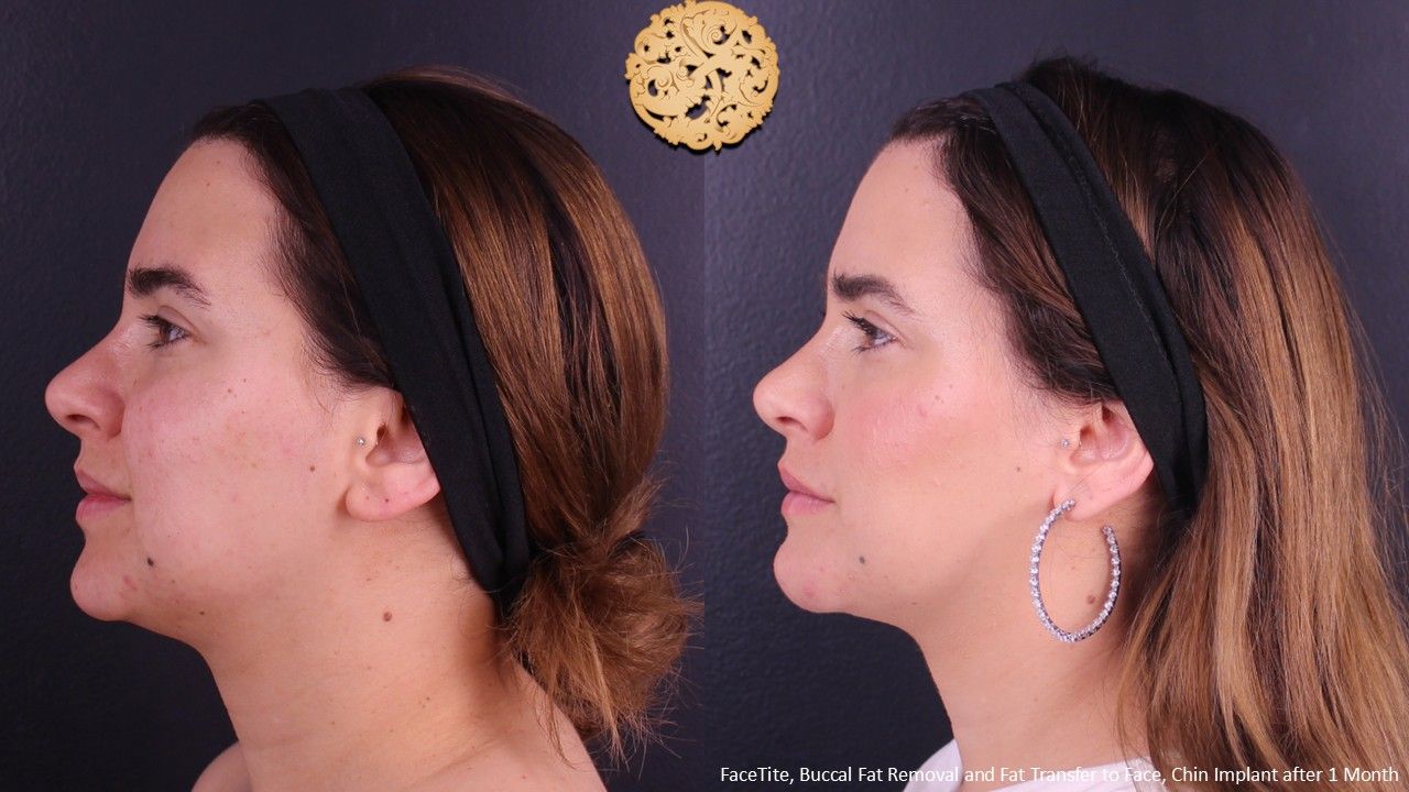 Buccal Fat Removal Before & After