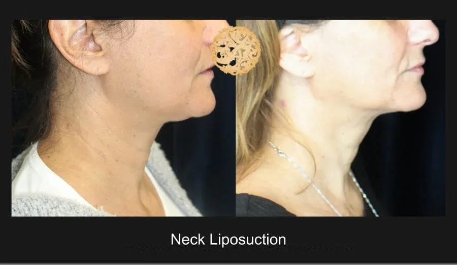 Neck Liposuction Before & After