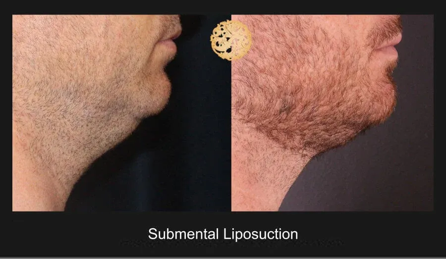 Neck Liposuction Before & After