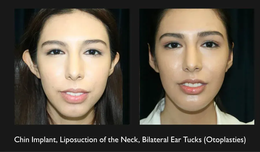 Neck Liposuction Before & After