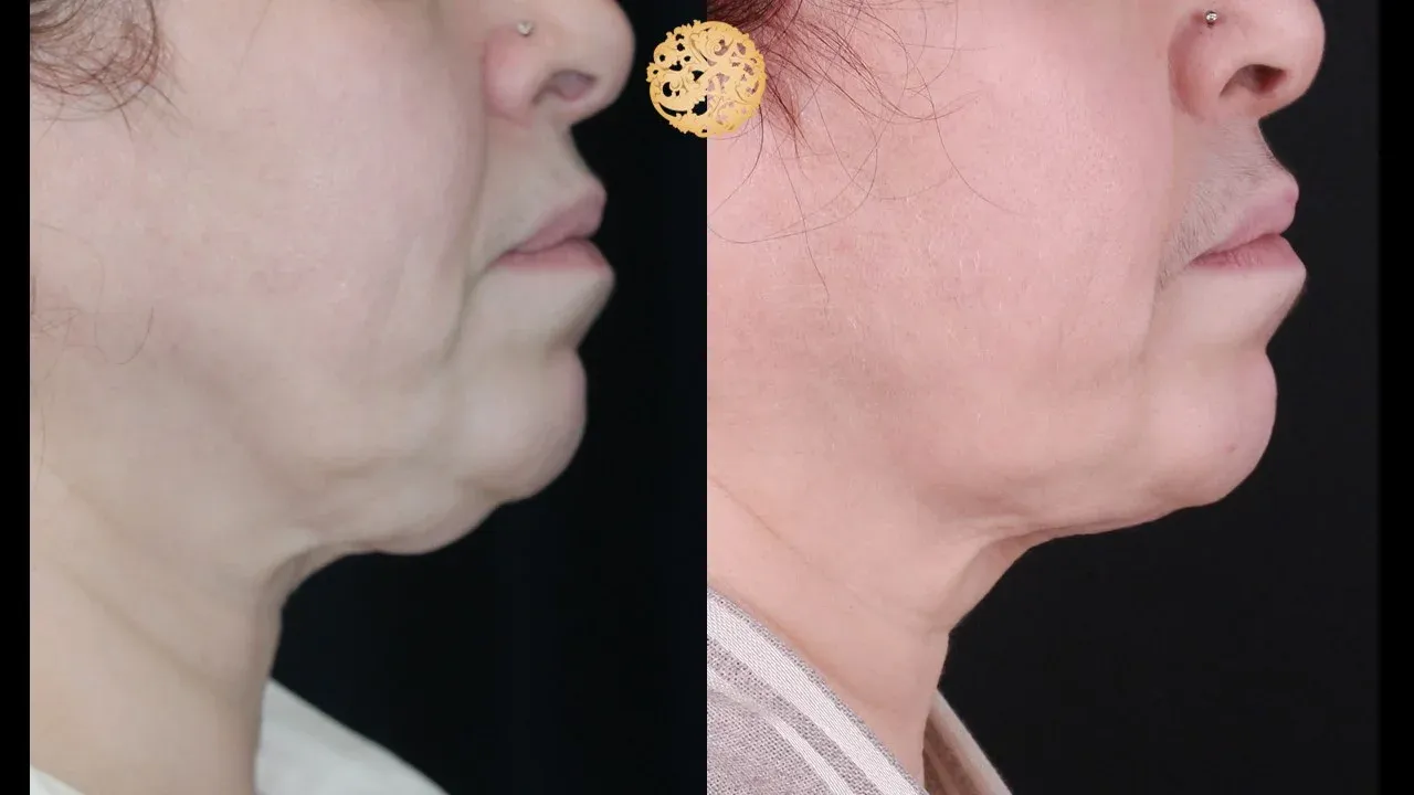 Neck Liposuction Before & After