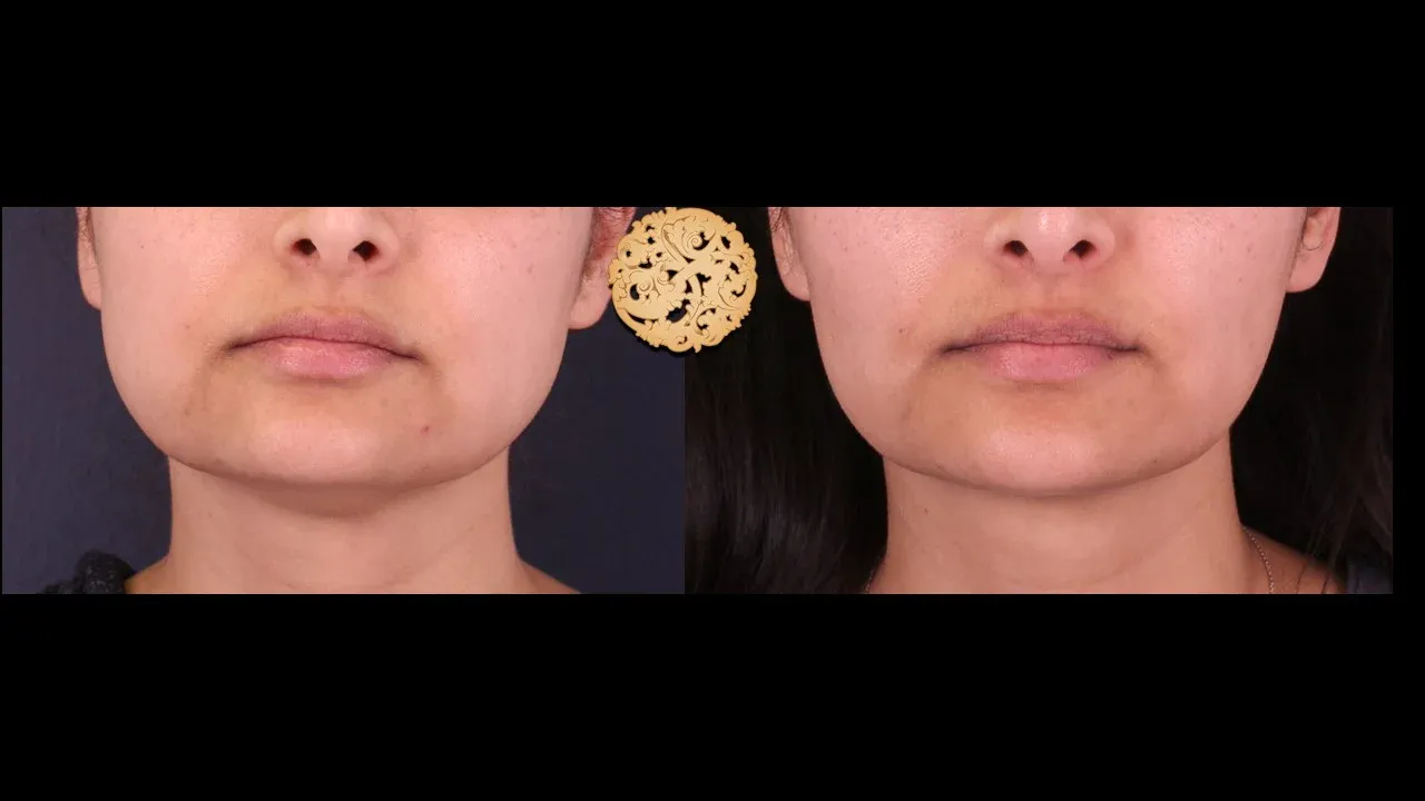 Neck Liposuction Before & After