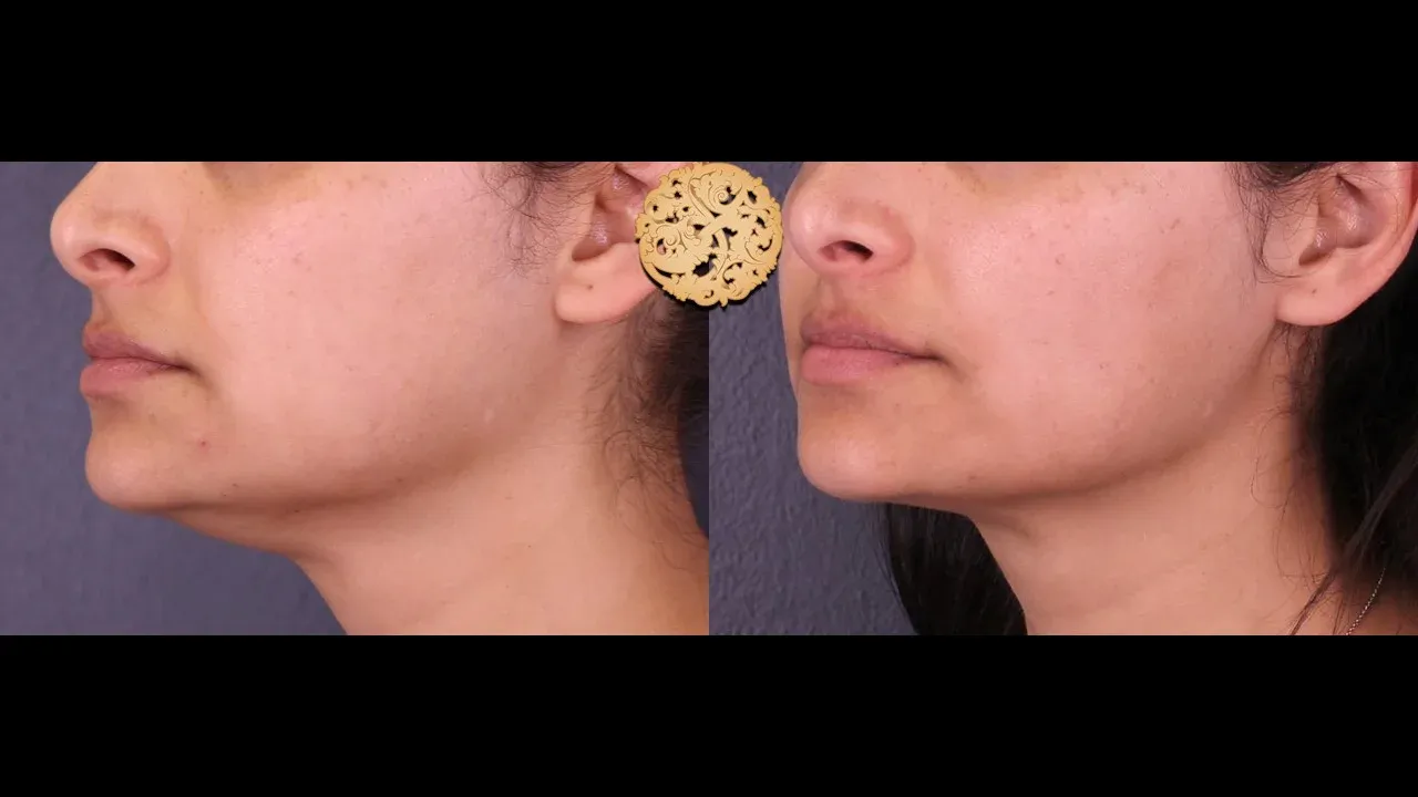 Neck Liposuction Before & After