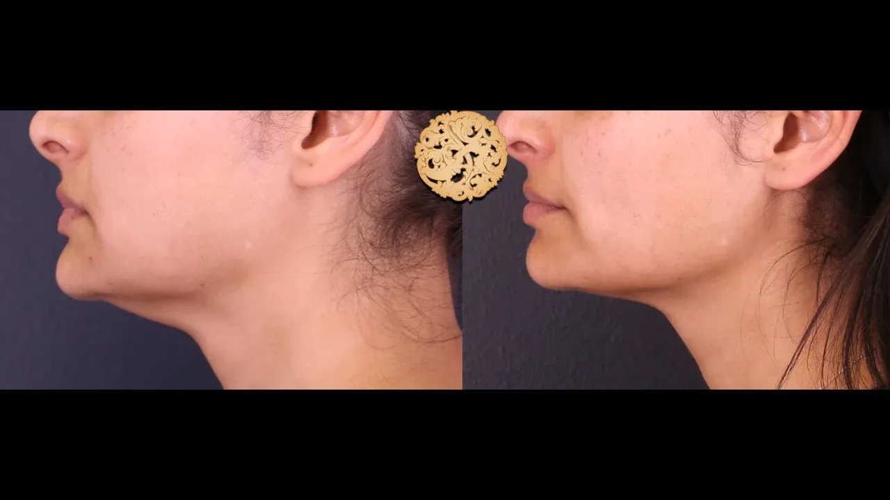 Neck Liposuction Before & After