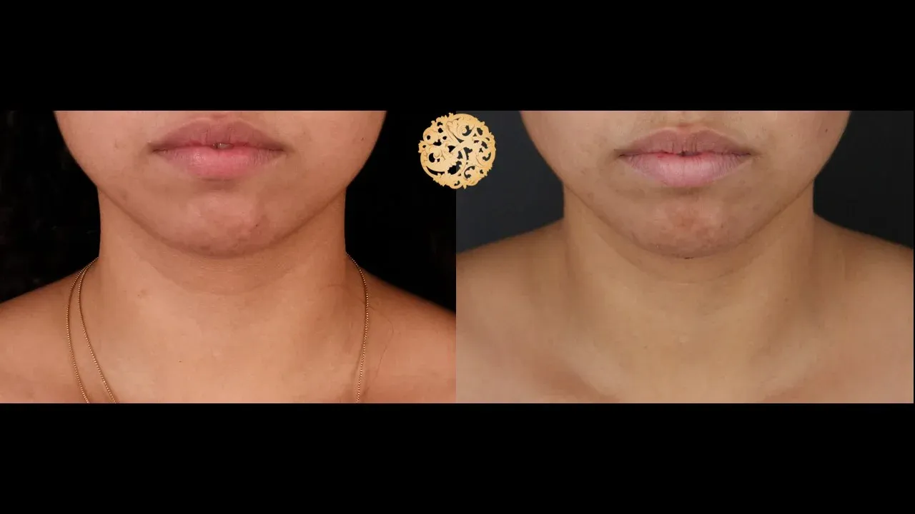 Neck Liposuction Before & After