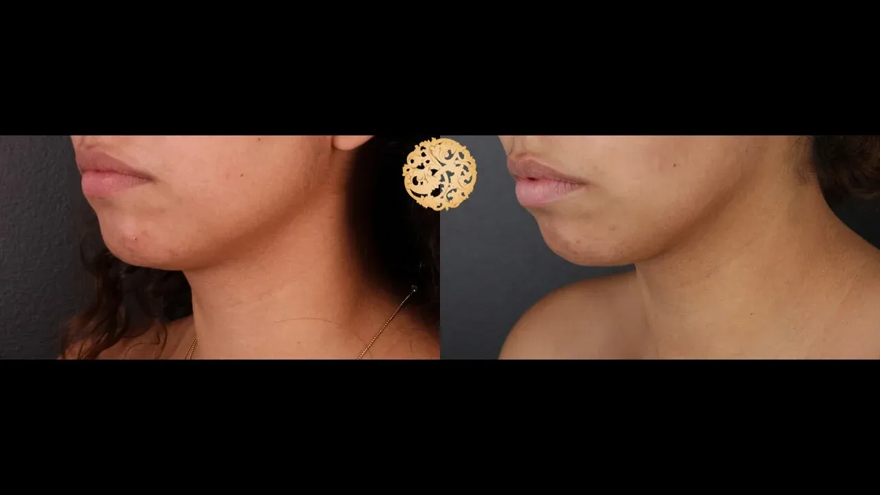 Neck Liposuction Before & After