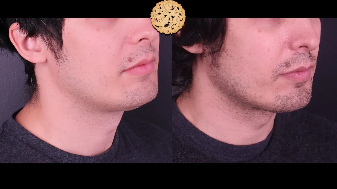 Neck Liposuction Before & After