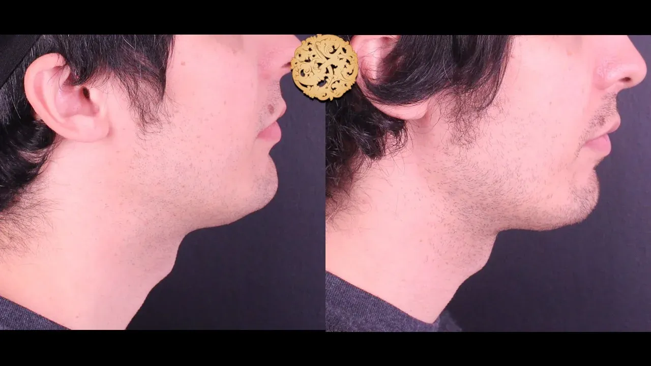 Neck Liposuction Before & After