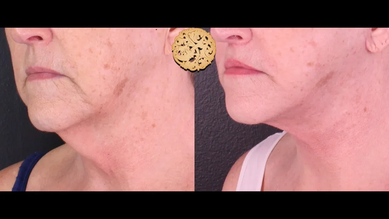 Neck Liposuction Before & After