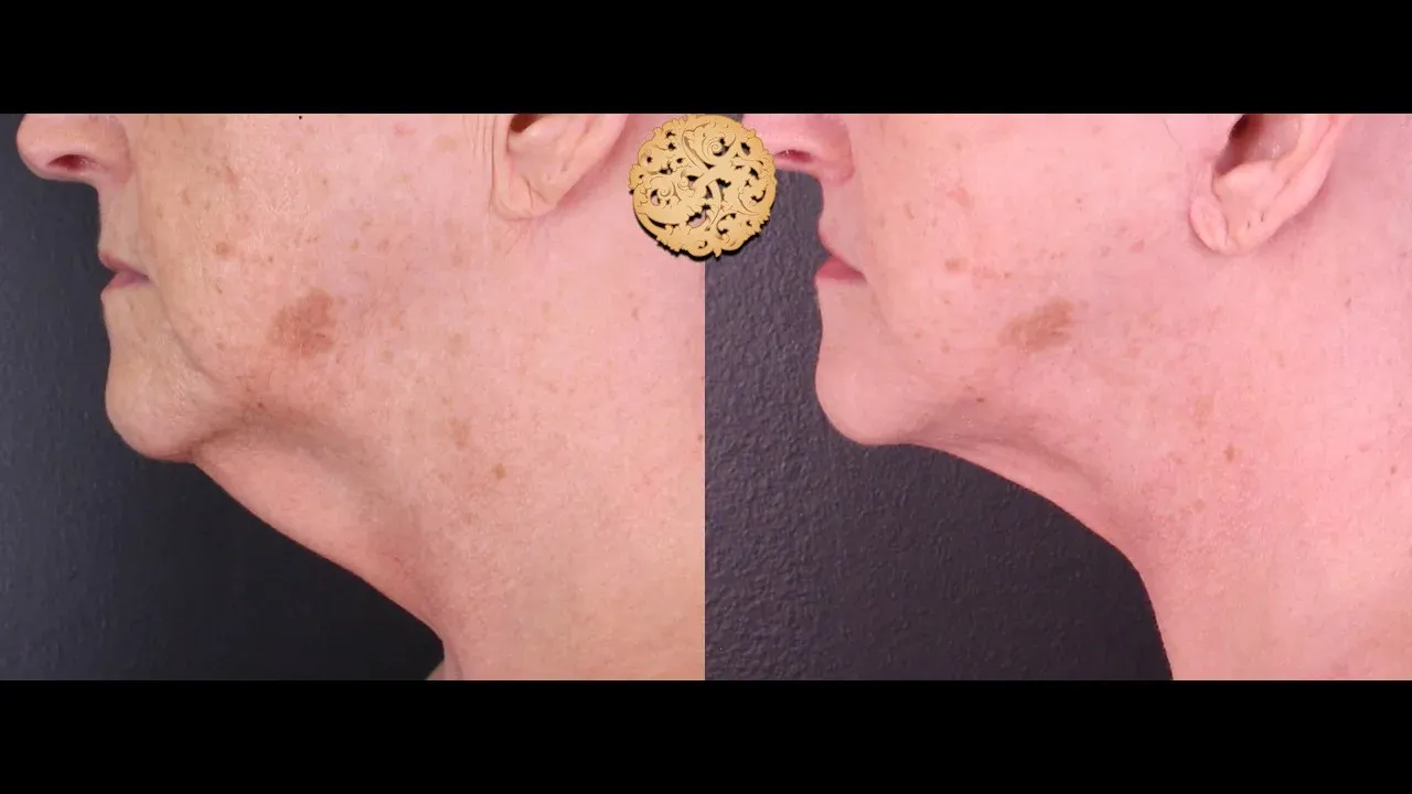 Neck Liposuction Before & After