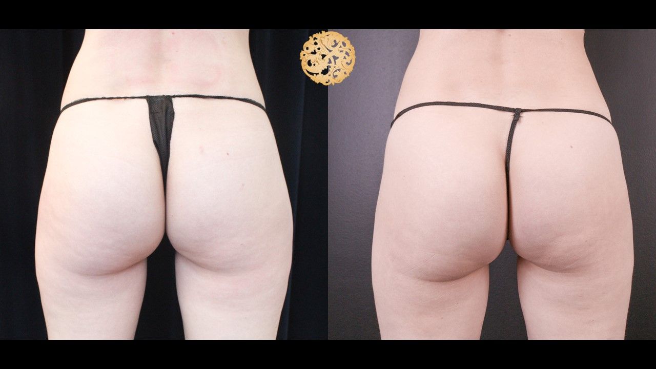 Non Surgical Butt Augmentation Before & After