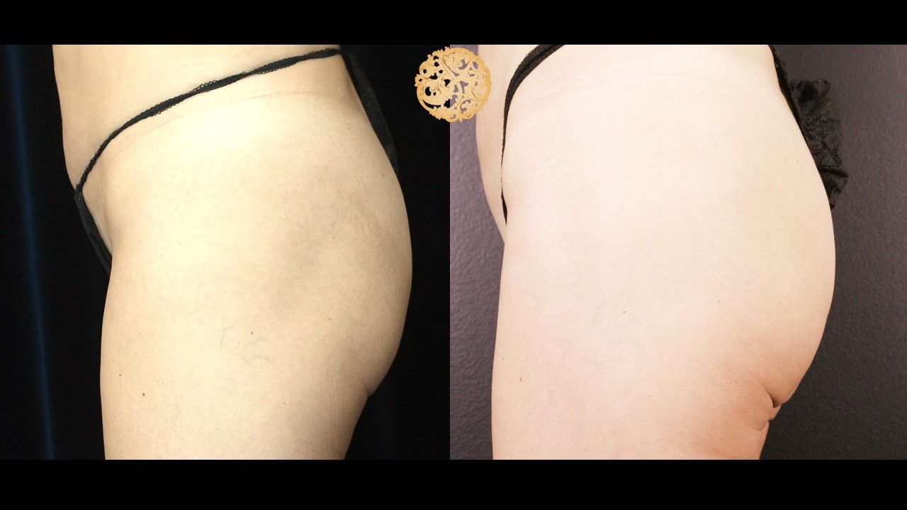 Non Surgical Butt Augmentation Before & After