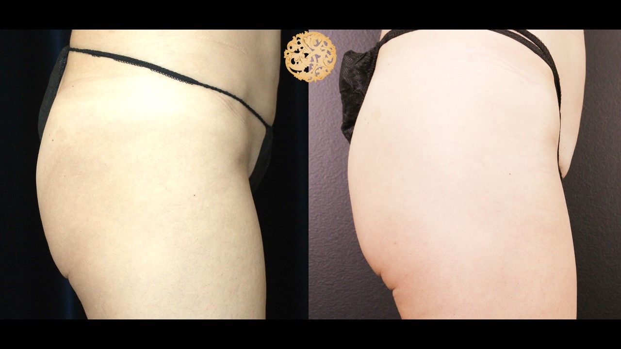 Non Surgical Butt Augmentation Before & After