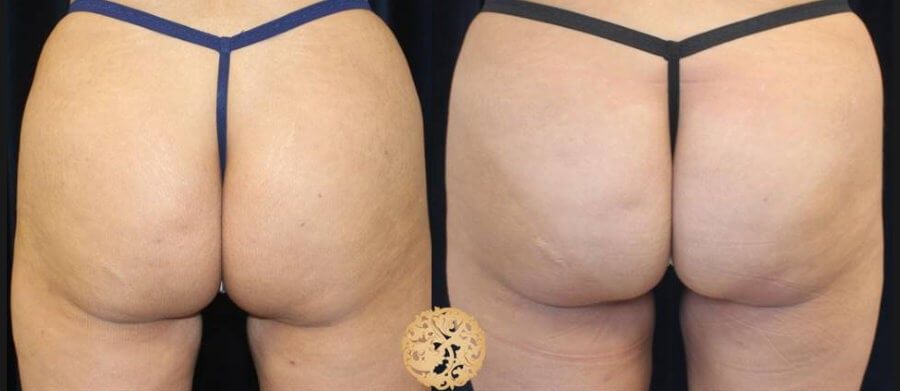 Non Surgical Butt Augmentation Before & After