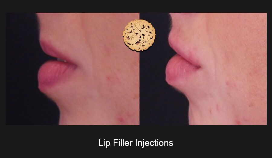 Lip Filler Before & After