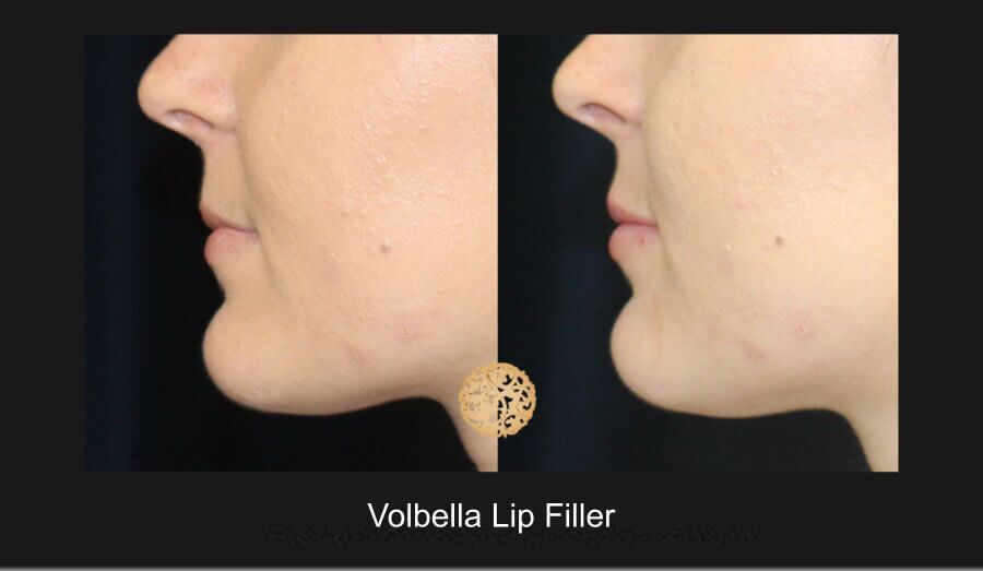 Lip Filler Before & After