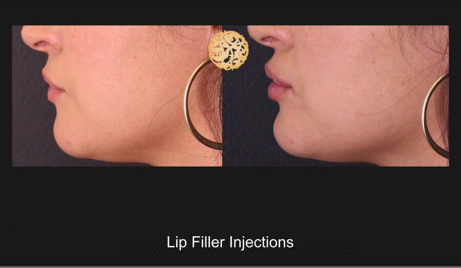 Lip Filler Before & After