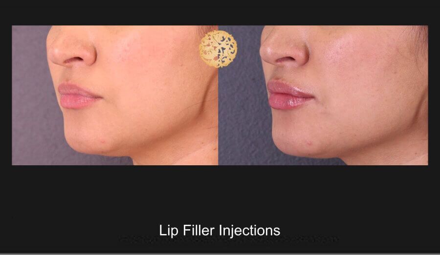 Lip Filler Before & After