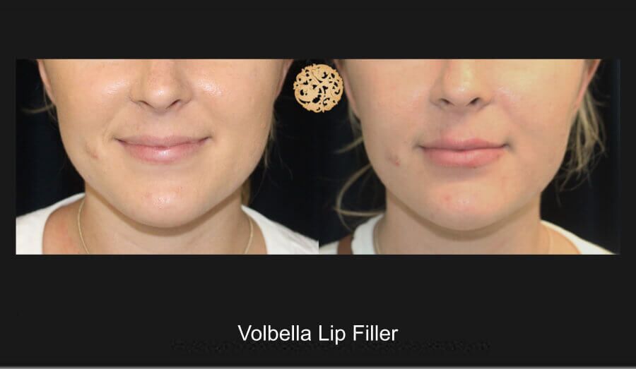 Lip Filler Before & After