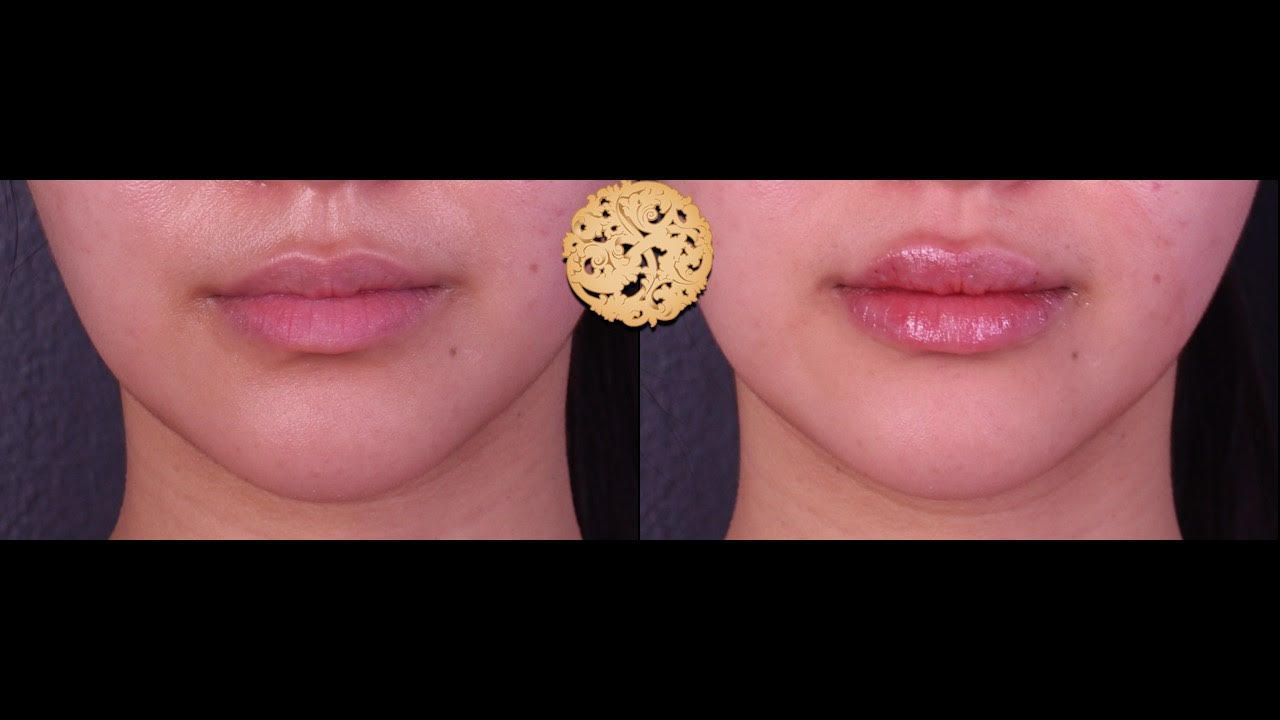 Lip Filler Before & After