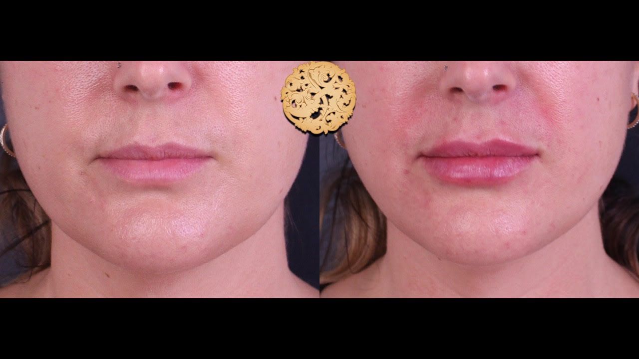 Lip Filler Before & After