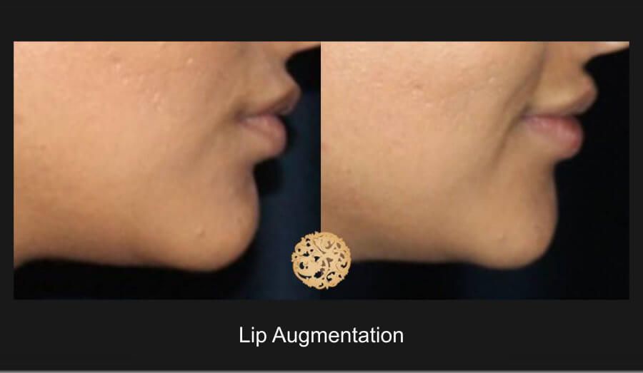 Lip Filler Before & After