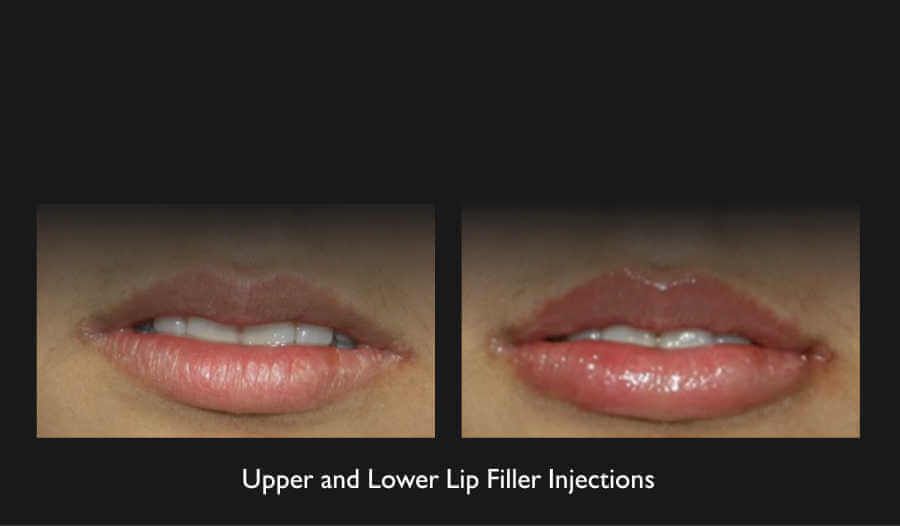 Lip Filler Before & After