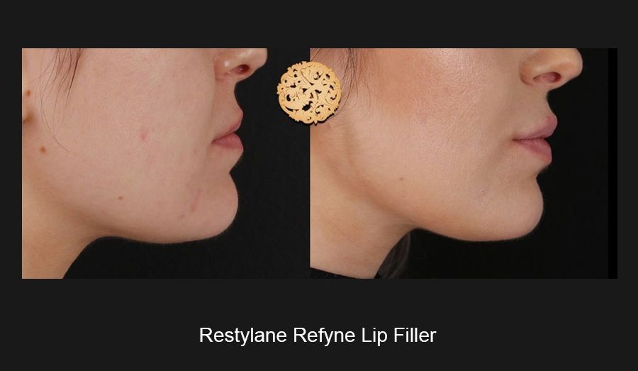 Lip Filler Before & After