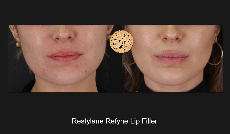 Lip Filler Before & After