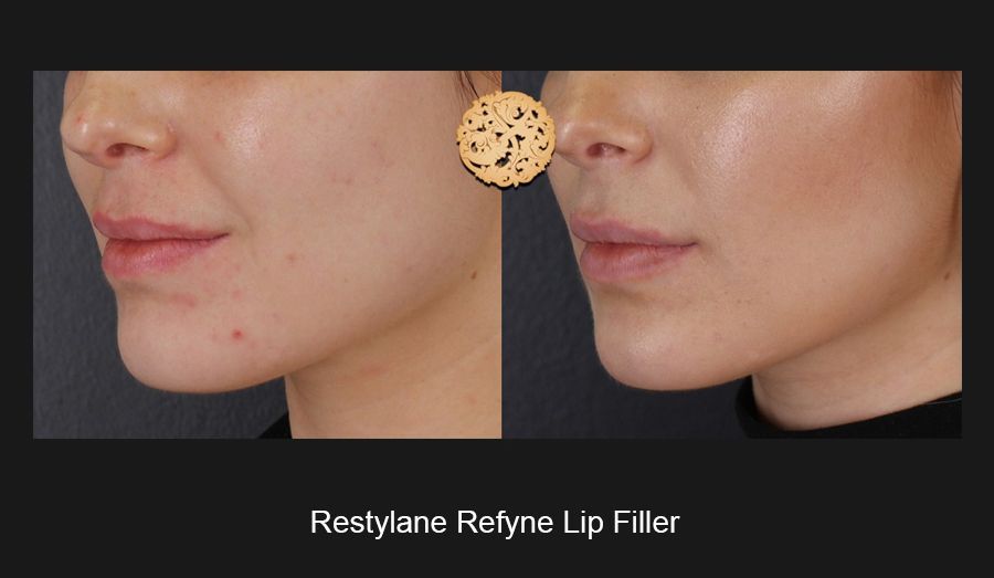 Lip Filler Before & After