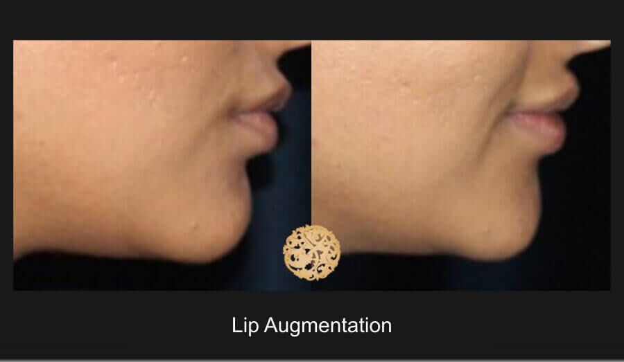 Lip Filler Before & After