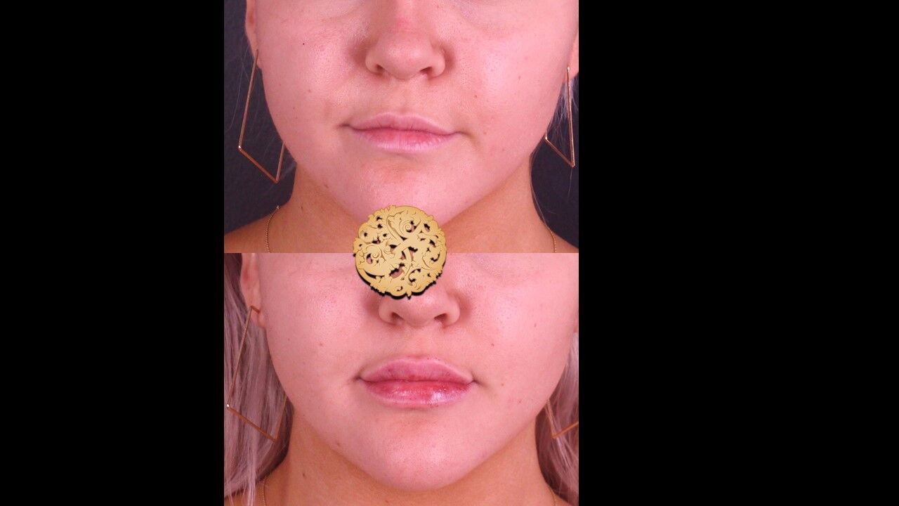 Lip Filler Before & After