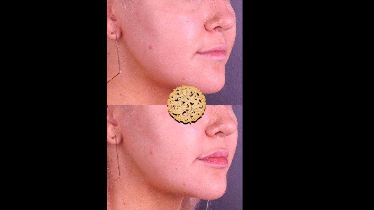 Lip Filler Before & After