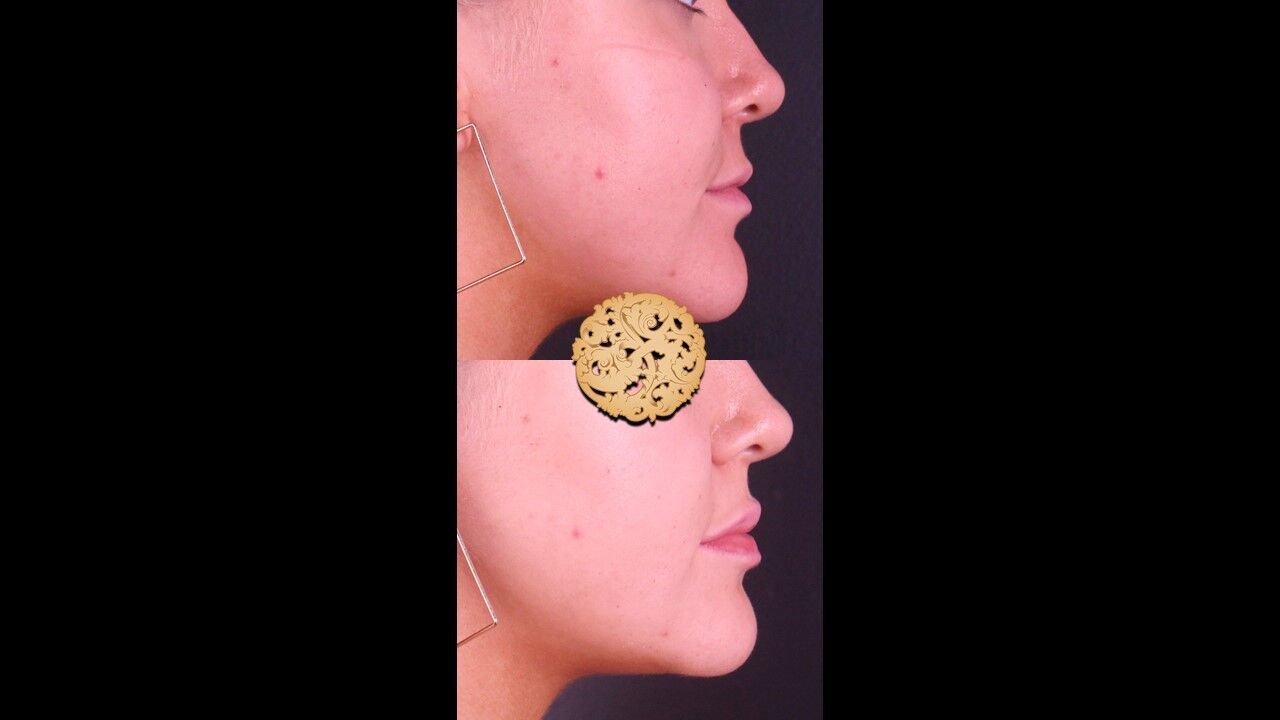 Lip Filler Before & After