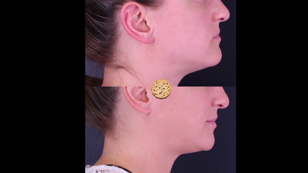 Lip Filler Before & After