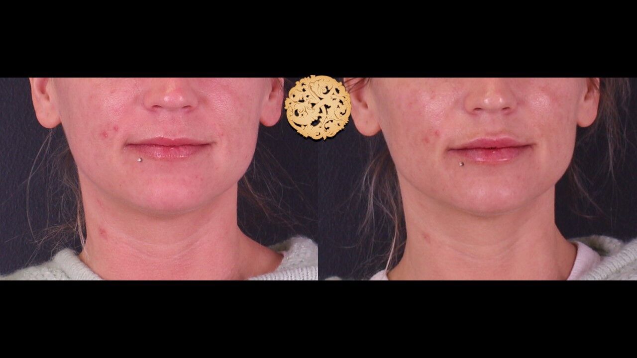 Lip Filler Before & After