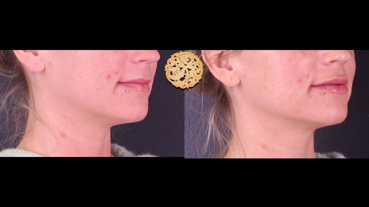 Lip Filler Before & After