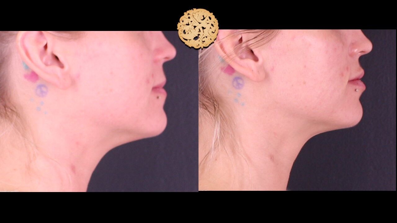 Lip Filler Before & After