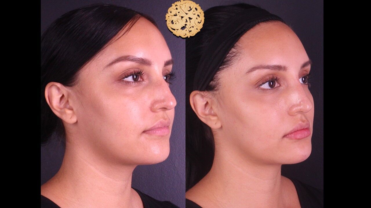 Lip Filler Before & After