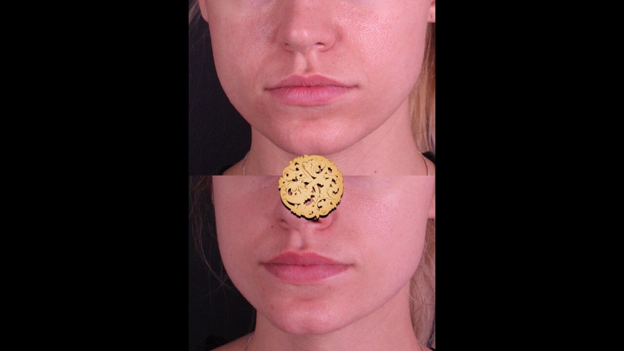 Lip Filler Before & After