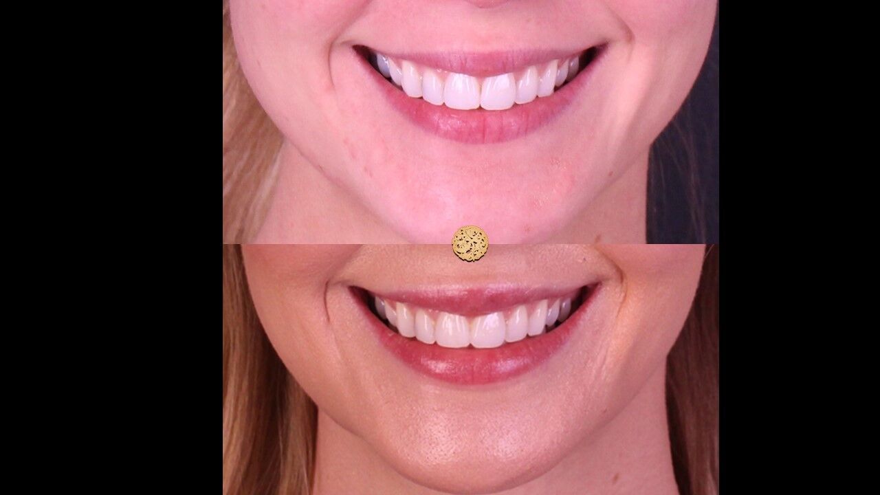 Lip Filler Before & After