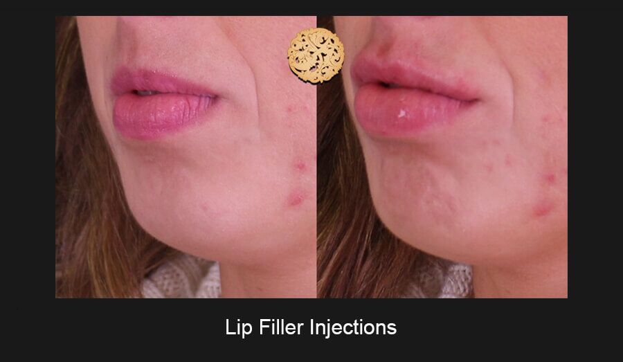 Lip Filler Before & After