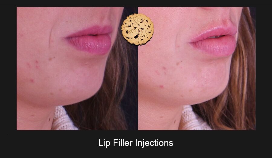 Lip Filler Before & After
