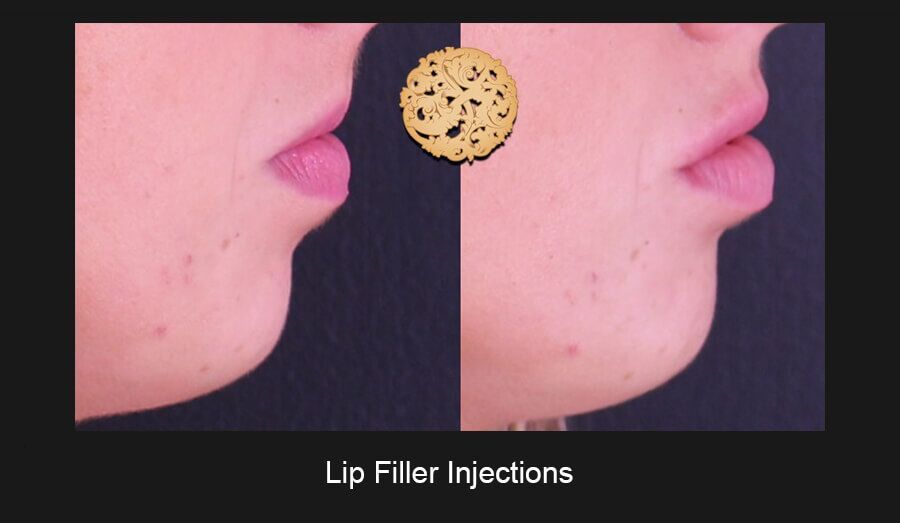 Lip Filler Before & After
