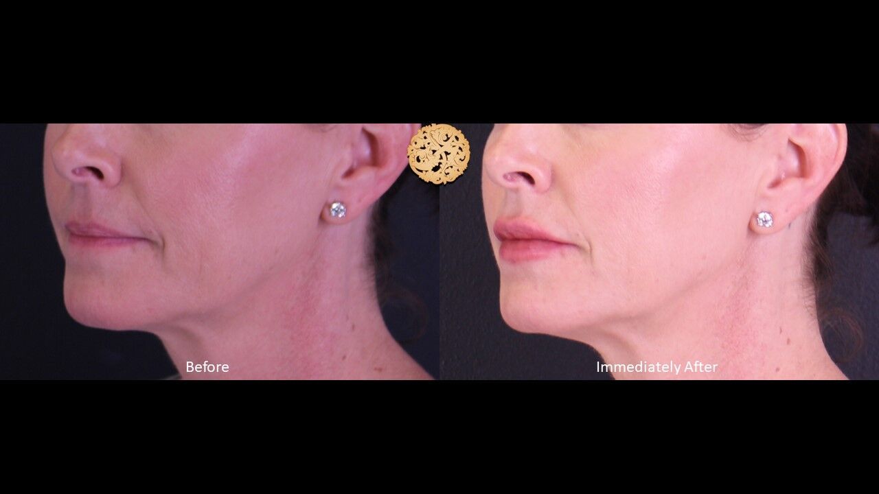 Lip Filler Before & After