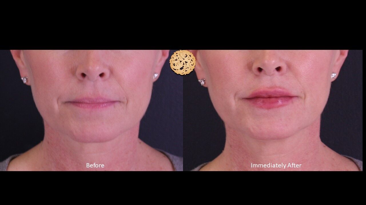 Lip Filler Before & After
