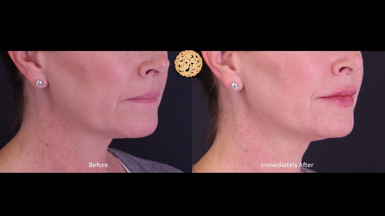 Lip Filler Before & After