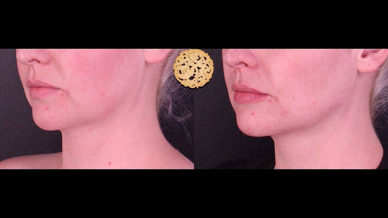 Lip Filler Before & After