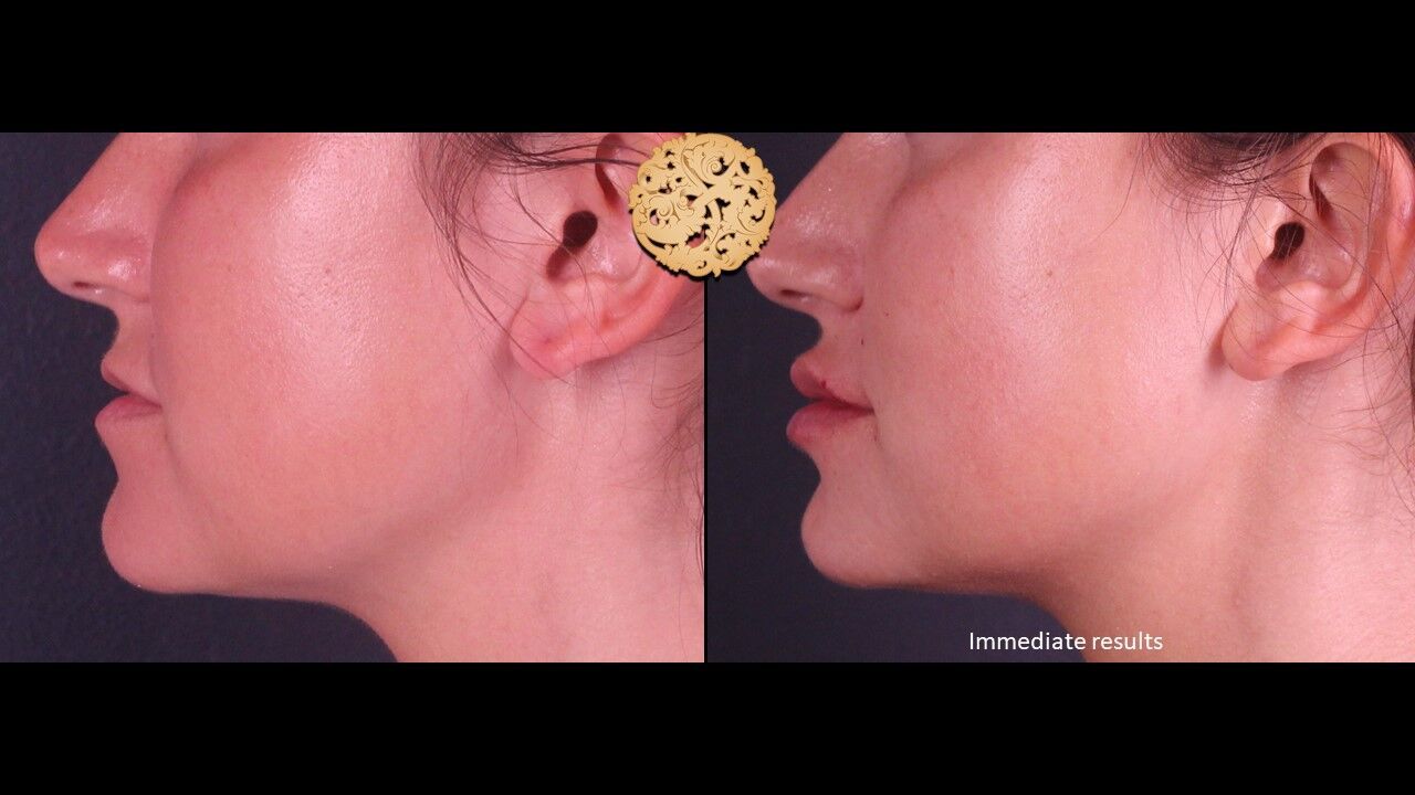 Lip Filler Before & After