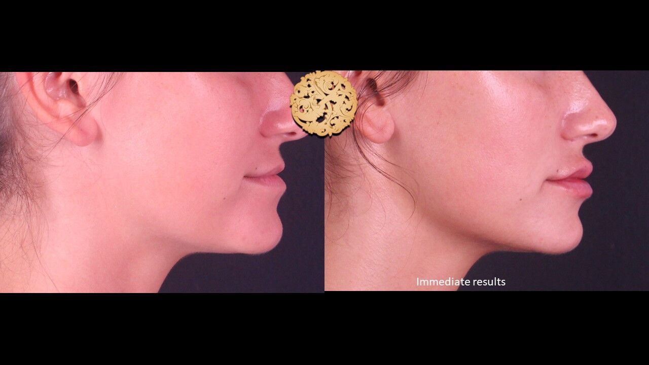 Lip Filler Before & After